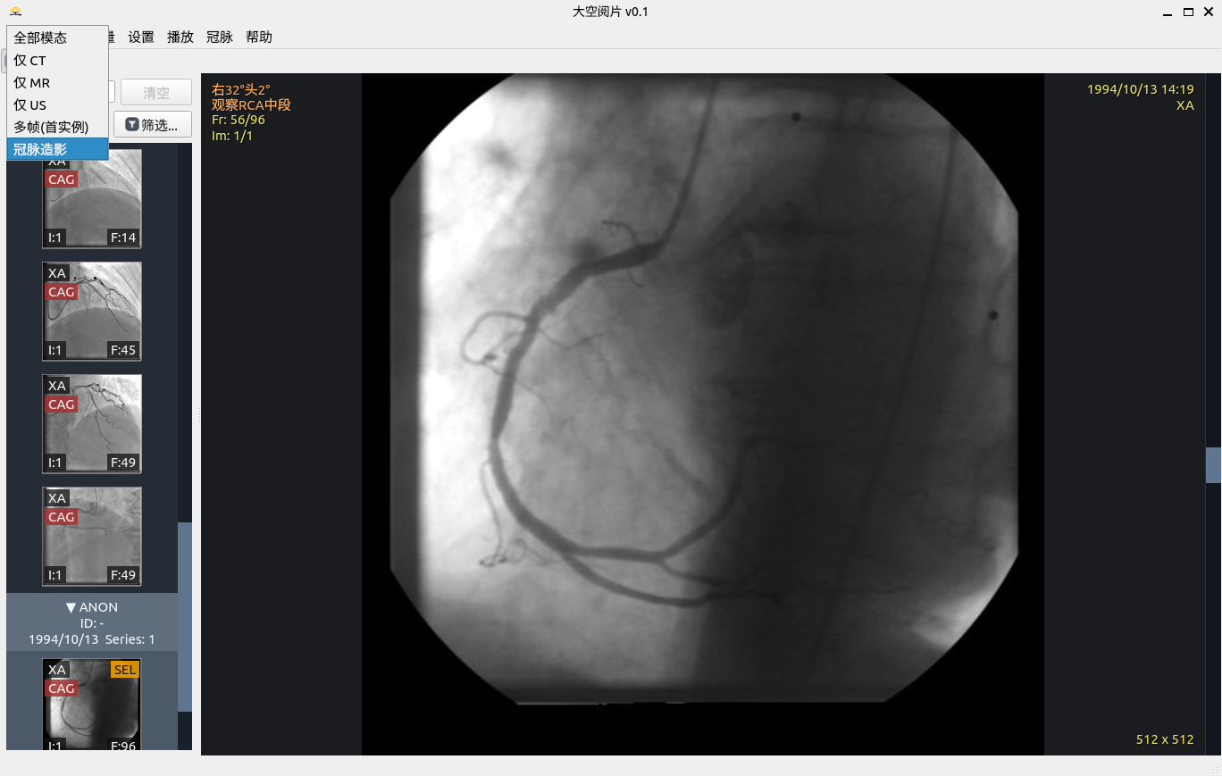 冠脉介入影像筛选